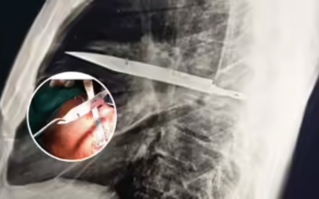 Knife stuck in the chest