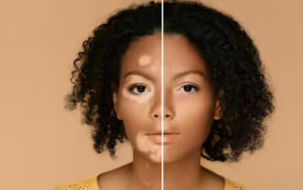 Vitiligo risk from curd