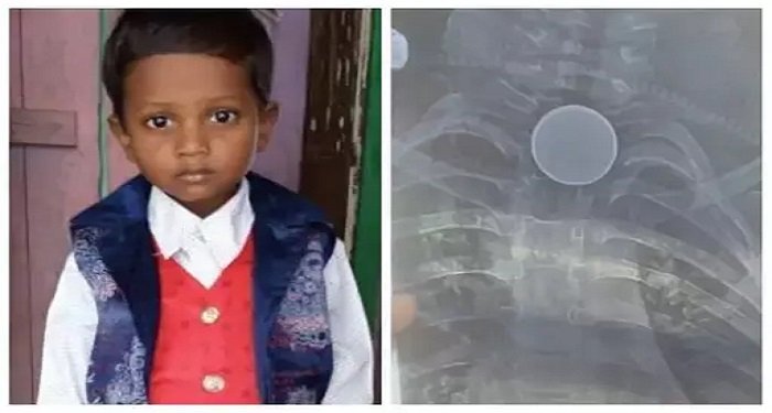 कोरबा में दर्दनाक हादसा, 8 साल के बच्चे की सीने में सिक्का फंसने से मौत