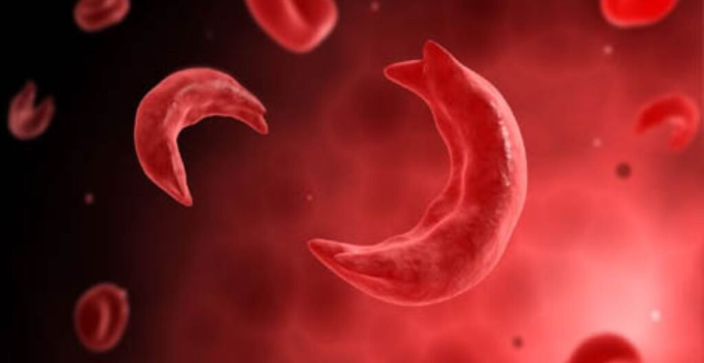 सिकल सेल