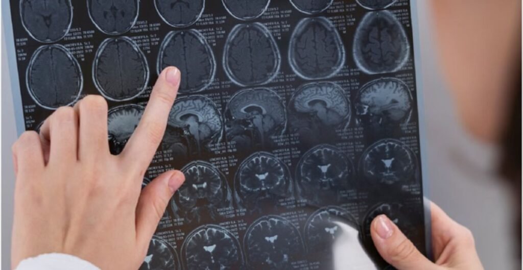 ब्रेन ट्यूमर