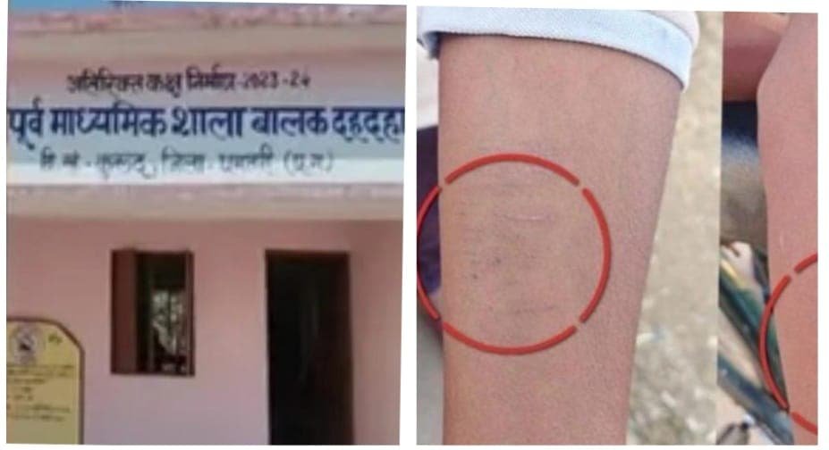 छत्तीसगढ़ धमतरी के स्कूल में सनसनी: 35 से ज्यादा छात्रों ने ब्लेड से काटे हाथ, जांच जारी